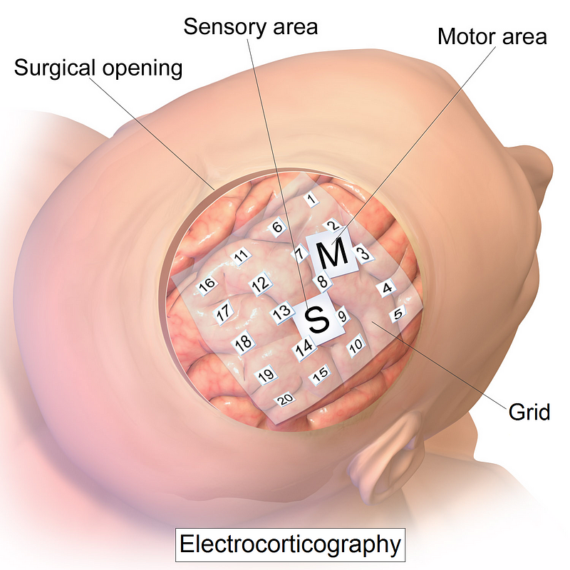 Electrocorticography example of partially invasive BCIs